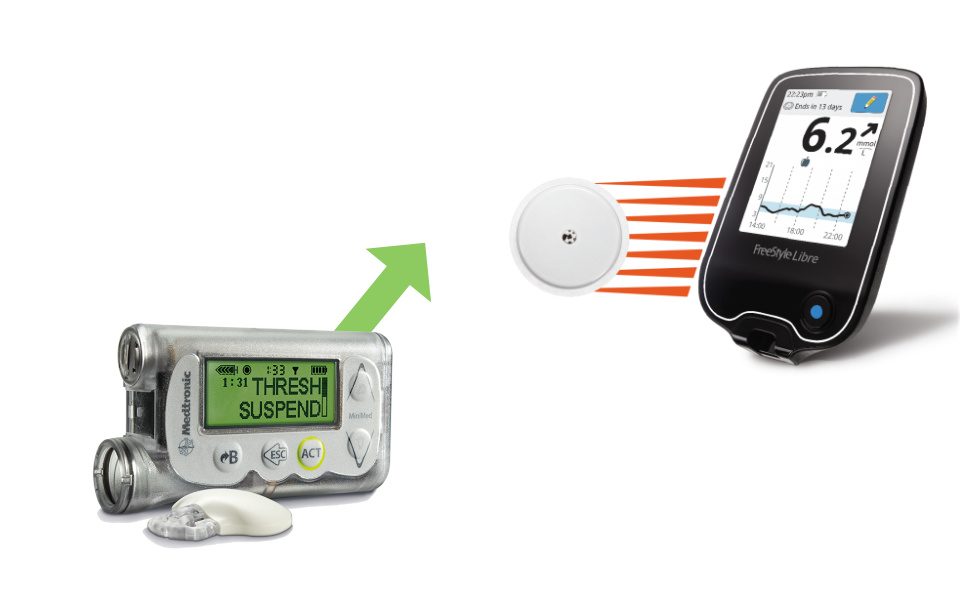 Progression and Advances in CGM Technology