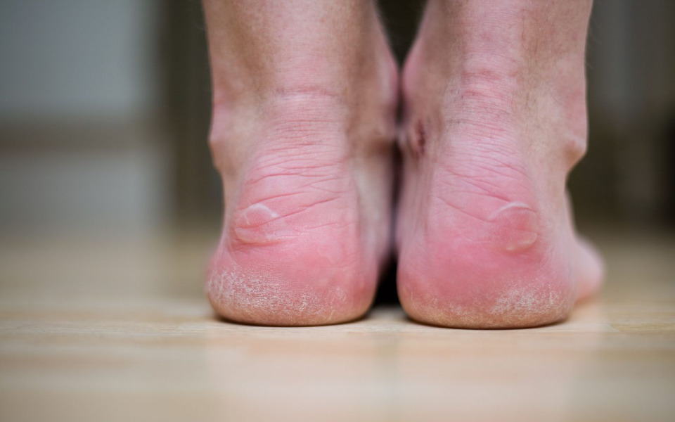 Common Foot Problems in Diabetic Patients