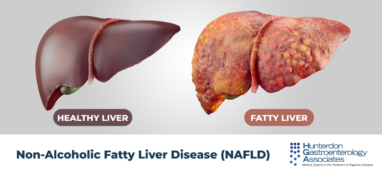 Diabetes and Liver Health