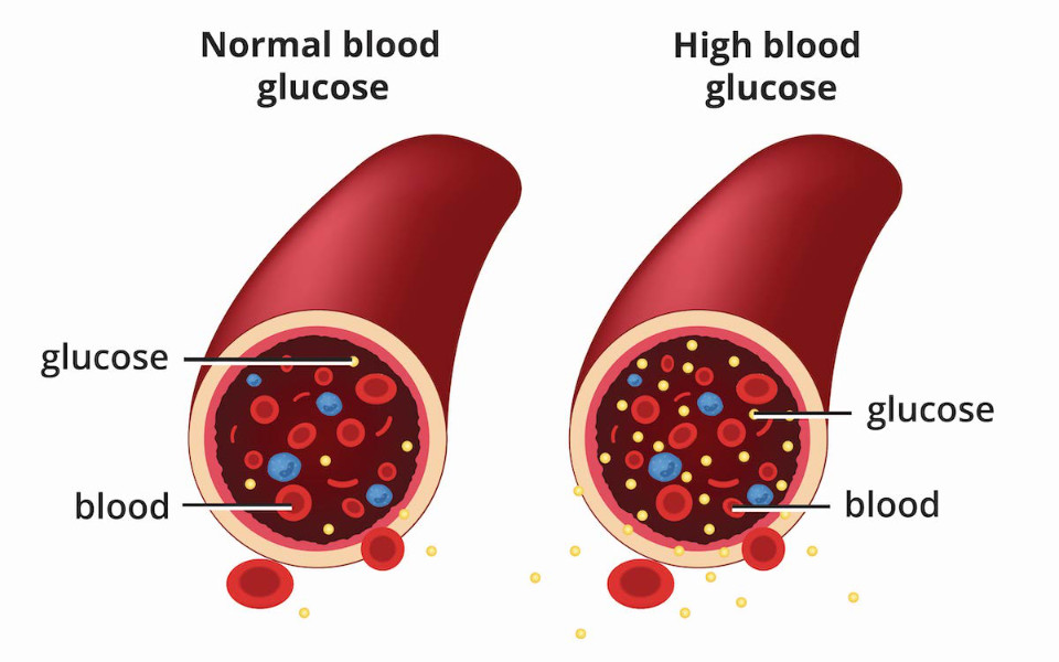 Types of Diabetes